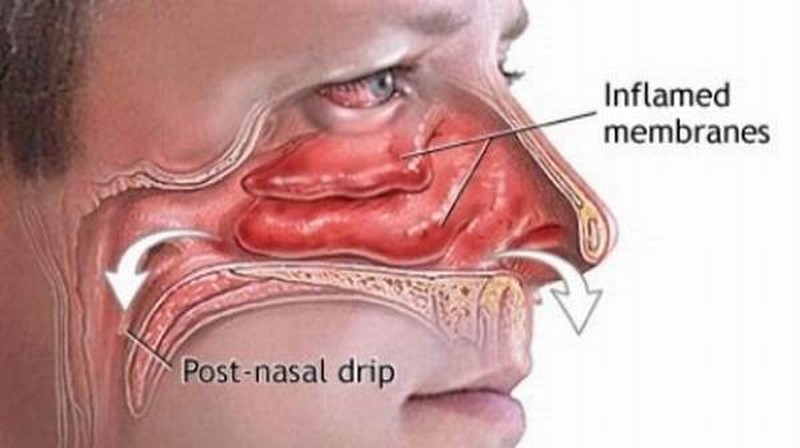 severe nasal congestion