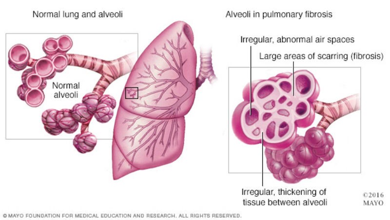 1 Hypersensitivity Pneumonitis